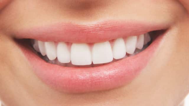 Lady with a radiant smile showcasing teeth brightening results